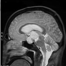 MRI demonstrating large pituitary tumor