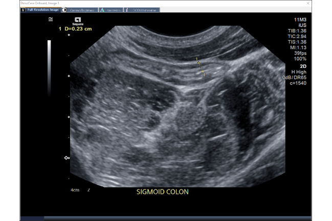 Ultrasound image of the sigmoid colon